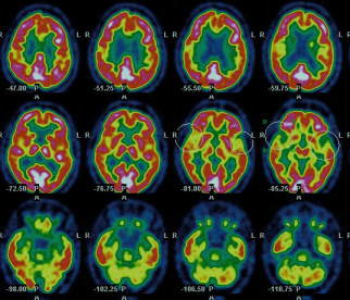 Your brain on drugs. Literally 4