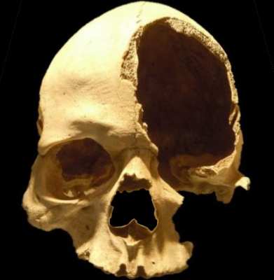 broken skull $